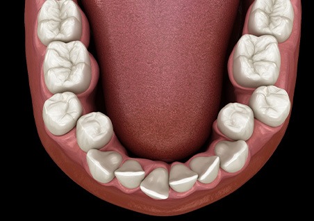 Illustration of crooked teeth