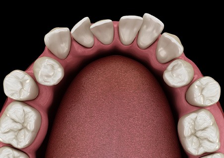 Illustration of gapped teeth
