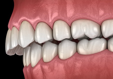 Illustration of an overbite