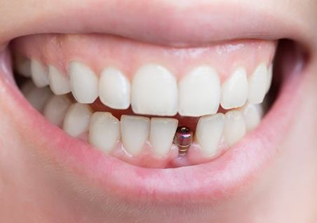 Smile with dental implant