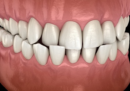Illustration of a crossbite
