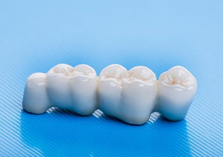 Dental bridges