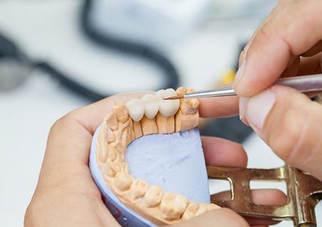 Dental bridge being crafted