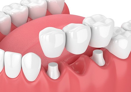 Illustration of traditional dental bridge