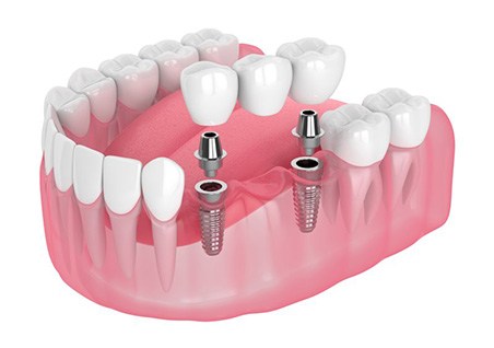 Illustration of implant bridge
