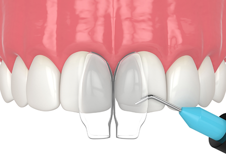 Illustration of bonding material being applied to a chipped tooth