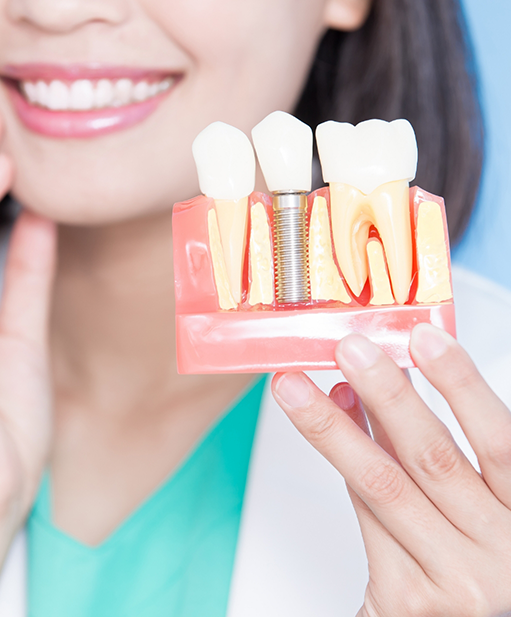 Dentist holding a model of a dental implant in Bellaire