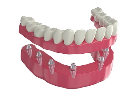 Rendering of implant dentures in lower arch with white background
