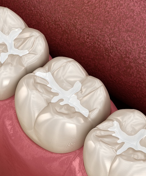 A CGI of tooth-colored fillings