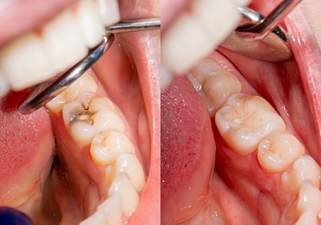 A before and after photo of teeth with tooth-colored fillings