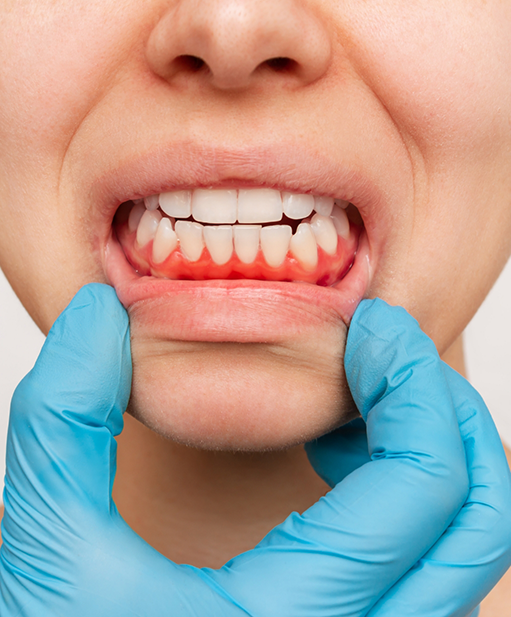 Close up of a mouth with red gums before gum disease treatment in Bellaire