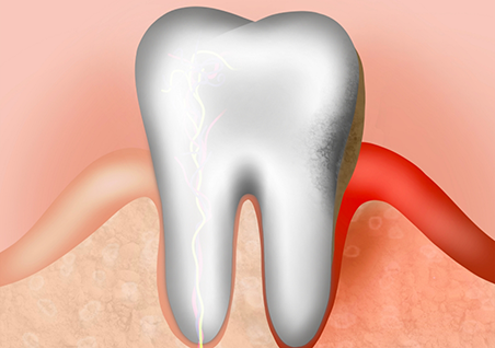 Illustration of a tooth with healthy gums on one side and red swollen gums on the other