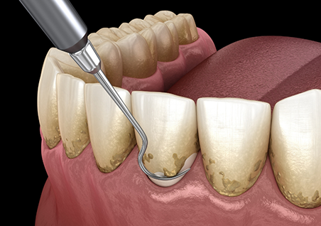 Illustration of a dental scaler clearing tartar buildup from the gumline