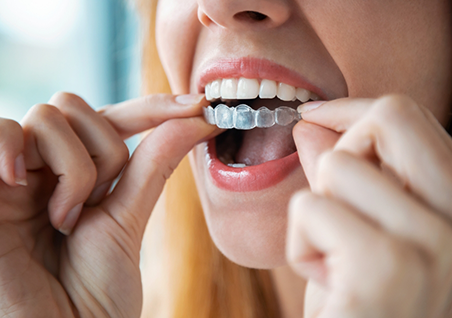 Close up of a blonde woman placing an Invisalign aligner over her teeth