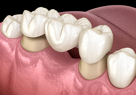 Illustration of a dental bridge replacing a missing tooth