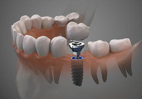Illustration of a dental implant with a crown replacing a missing lower tooth