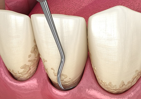 A CGI closeup of root planing