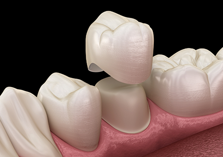 Illustration of a dental crown being fitted over a tooth