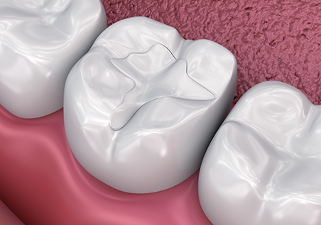 Illustration of a tooth with a white filling