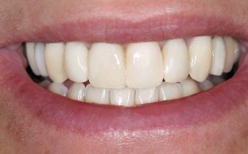 Close up of a smile with newly restored and whiter teeth