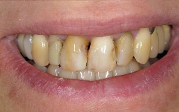Close up of a smile with yellowed and damaged teeth