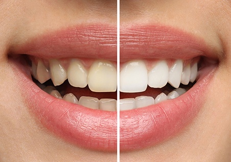 Patient's smile before and after teeth whitening