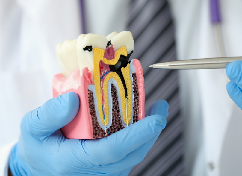 Dental model of a tooth with a cavity