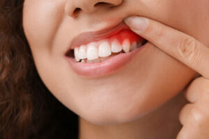 Woman pulling up lip to reveal red gum.